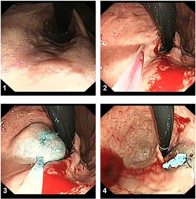 Endoscopic variceal ligation combined with sclerotherapy for management of gastroesophageal variceal bleeding in pediatric patients: a single-center retrospective study
